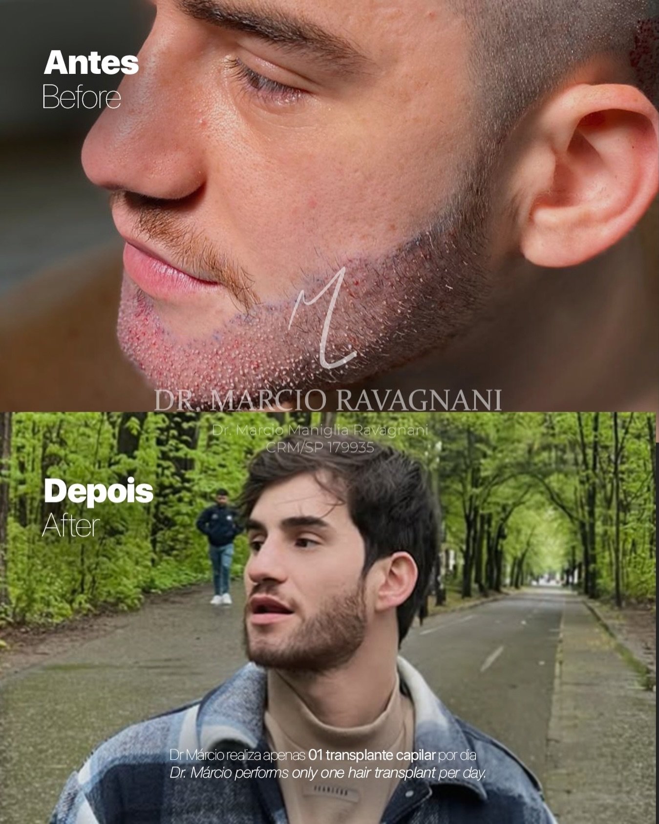 Antes e depois — caso 3 do Dr. Márcio Ravagnani