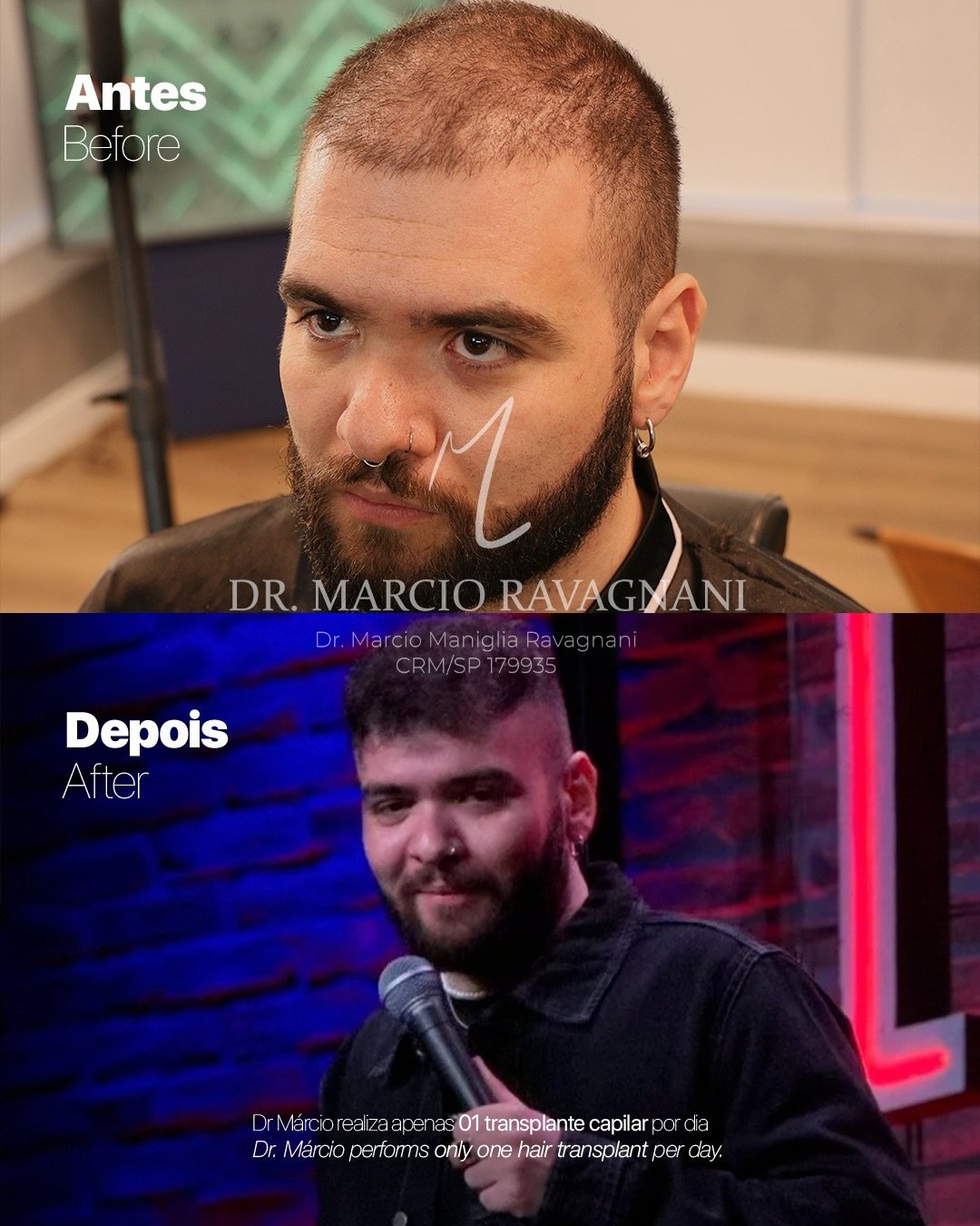 Antes e depois — caso 5 do Dr. Márcio Ravagnani