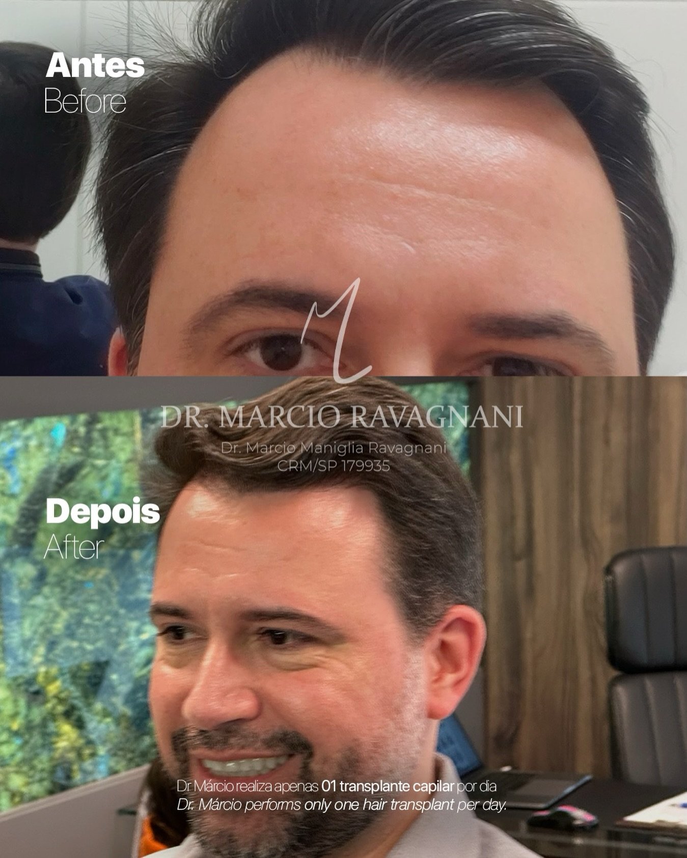 Antes e depois — caso 9 do Dr. Márcio Ravagnani