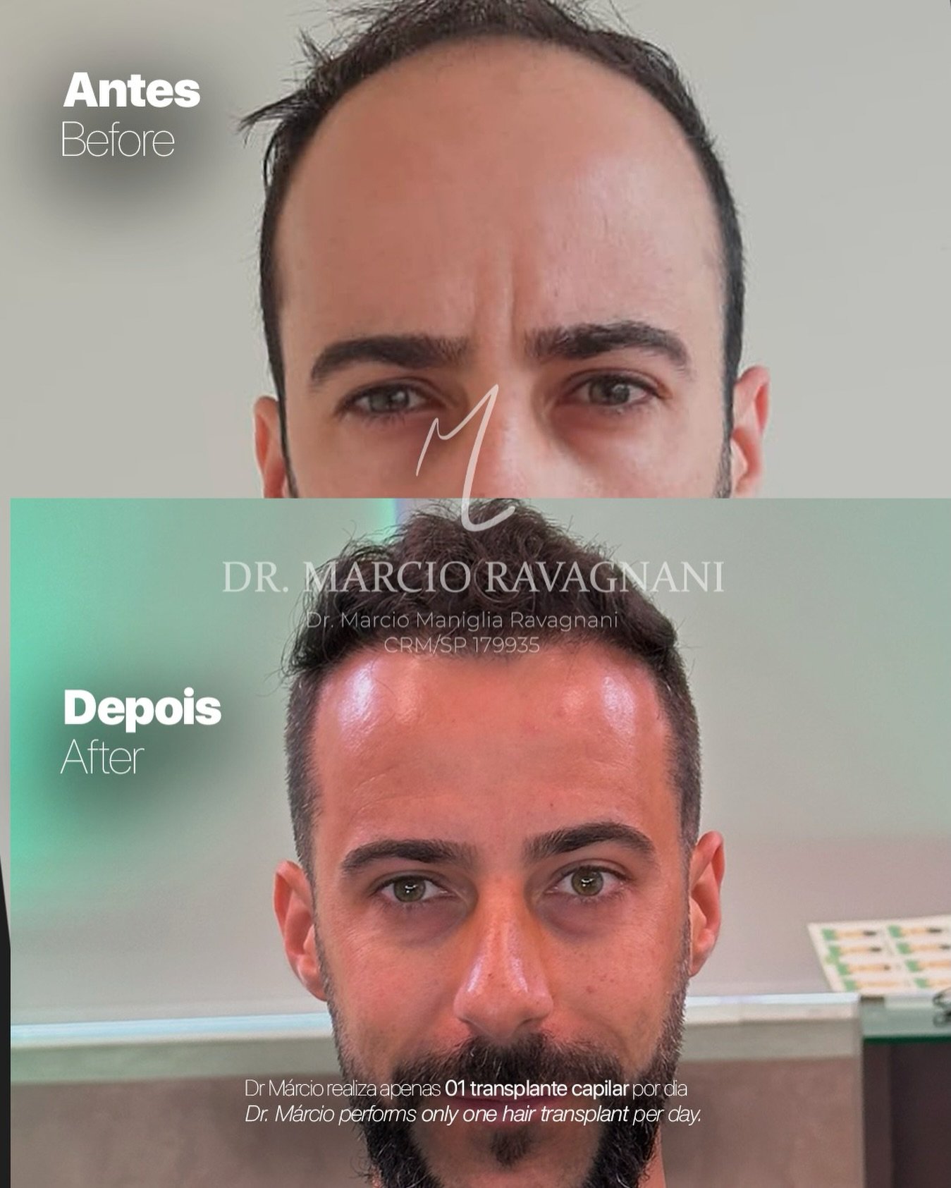 Antes e depois — caso 4 do Dr. Márcio Ravagnani