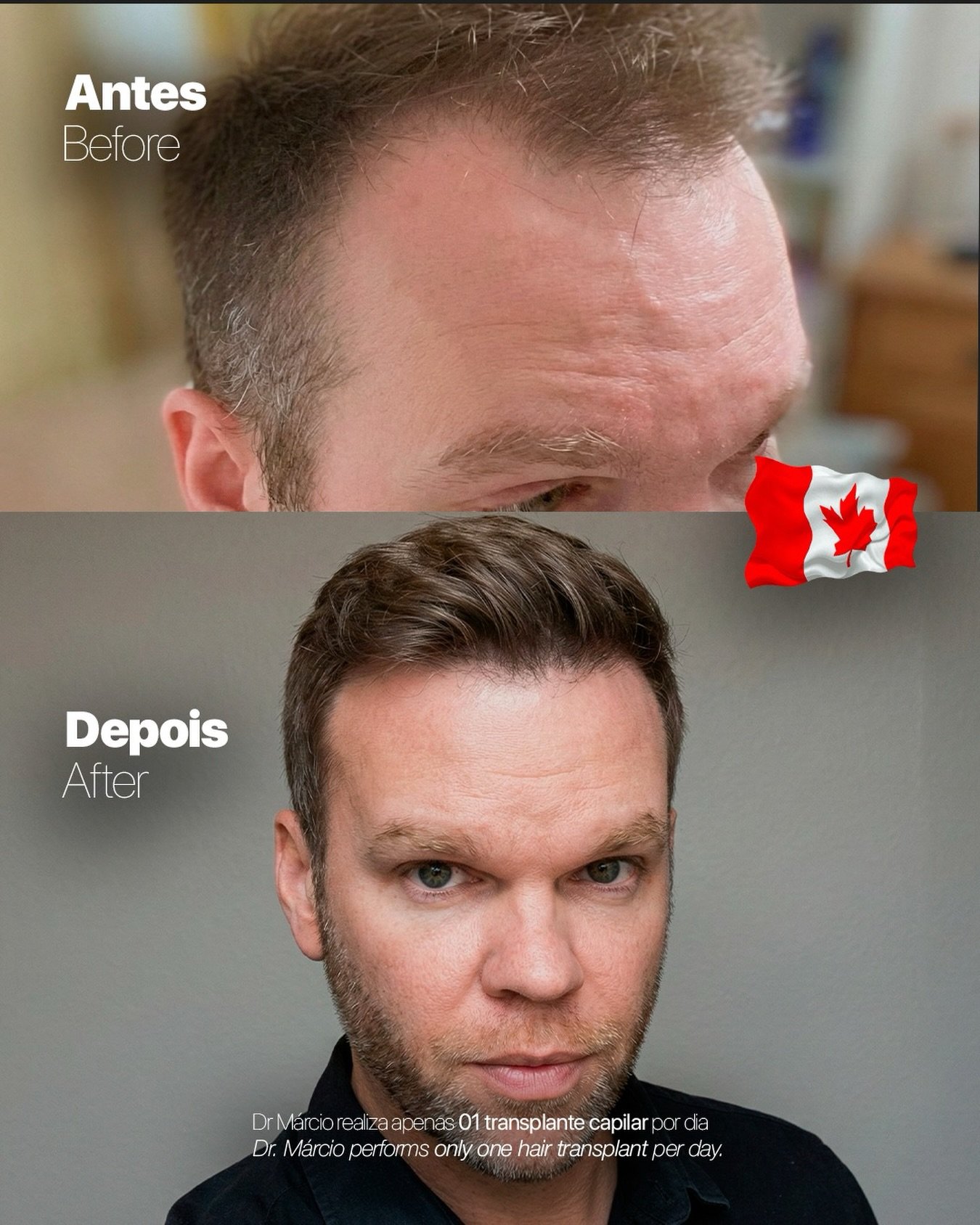 Antes e depois — caso 7 do Dr. Márcio Ravagnani