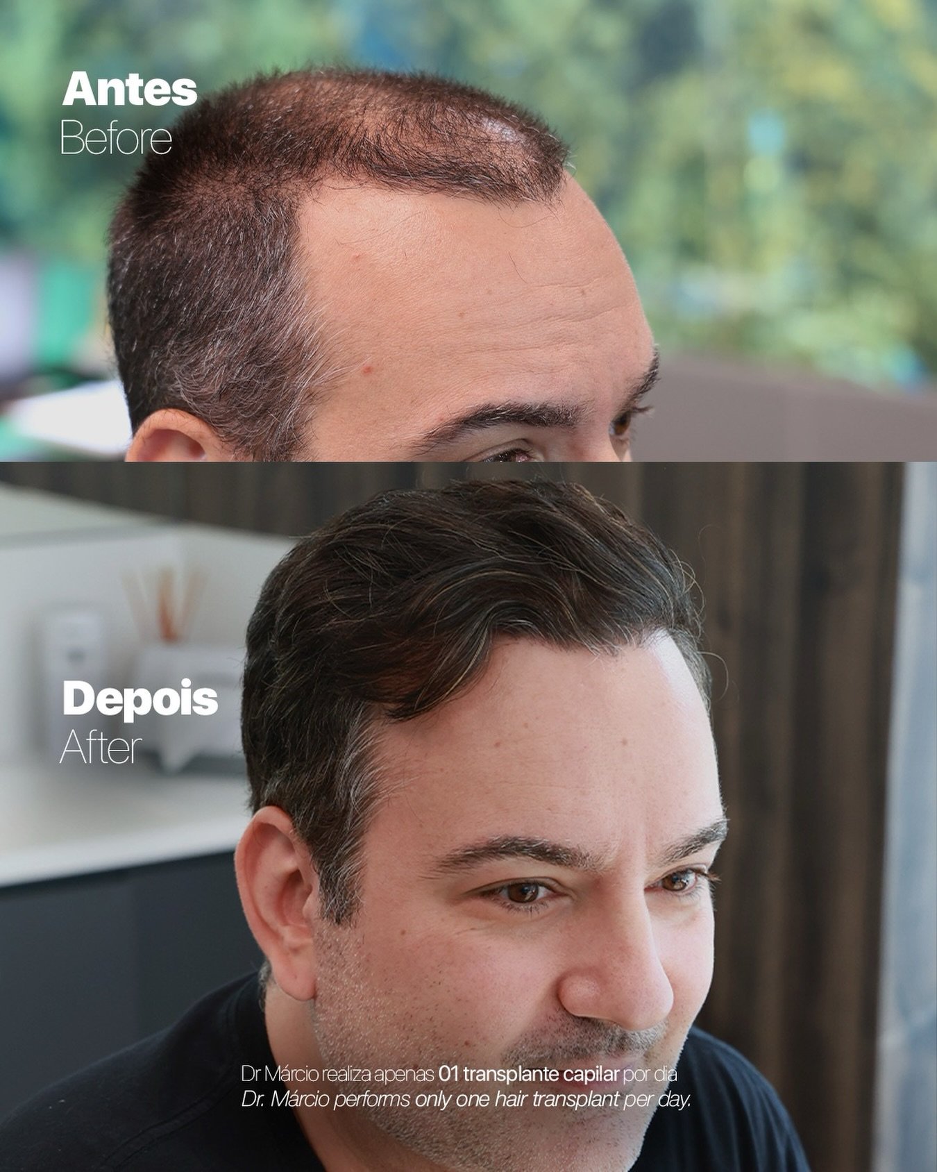 Antes e depois — caso 6 do Dr. Márcio Ravagnani